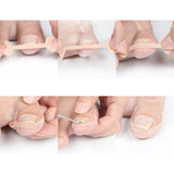 Ingrown Toenail Breathable Self-Adhesive Elastic Toenail Correction Patch