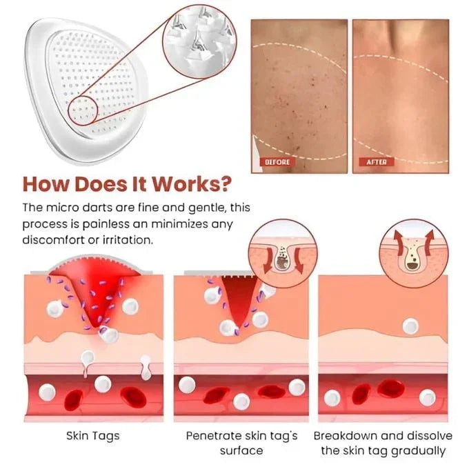 DERMA SMOOTH® SKIN TAG REMOVER PATCH - Pack of 100