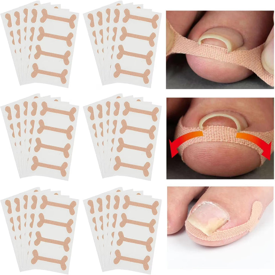 Ingrown Toenail Breathable Self-Adhesive Elastic Toenail Correction Patch