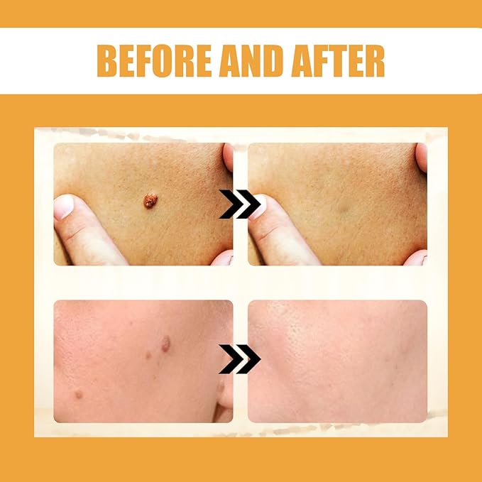 Ximonth Bee Venom Wart Cream