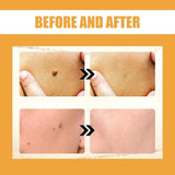 Ximonth Bee Venom Wart Cream