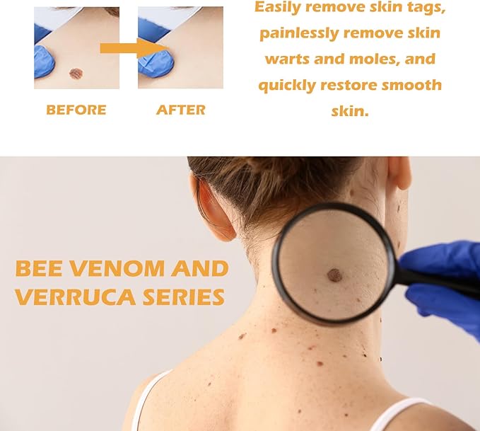 Ximonth Bee Venom Wart Cream
