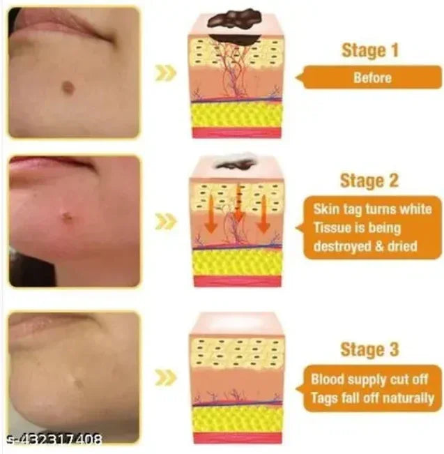 DERMA SMOOTH® SKIN TAG REMOVER PATCH - Pack of 100
