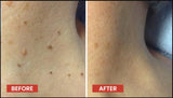 DERMA SMOOTH® SKIN TAG REMOVER PATCH - Pack of 100